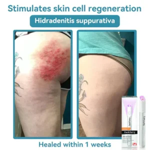 DarkFairy™ All-in-One CO₂ Laser Eraser Pen