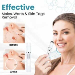 Non-Invasive Mole and Wart Removal Laser Pen image Non-Invasive Mole and Wart Removal Laser Pen