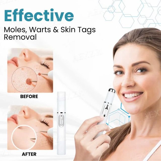 Non-Invasive Mole and Wart Removal Laser Pen image Non-Invasive Mole and Wart Removal Laser Pen