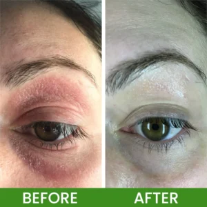 LIMETOW® Herbal Tinea Itching Cream image LIMETOW® Herbal Tinea Itching Cream