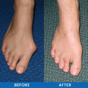 LIMETOW® Bunion-Free Solution