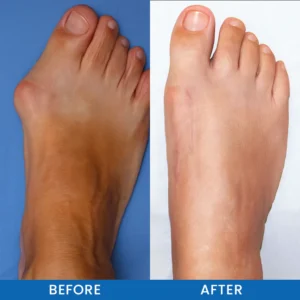 LIMETOW® Bunion-Free Solution