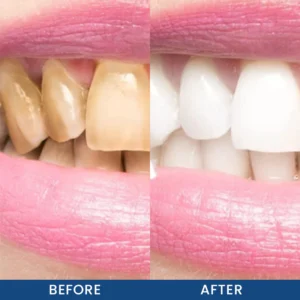LIMETOW® Teeth Whitening Essence image LIMETOW® Teeth Whitening Essence
