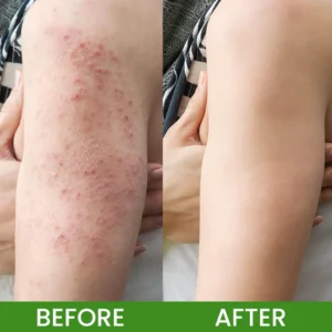 LIMETOW® Herbal Tinea Itching Cream image LIMETOW® Herbal Tinea Itching Cream