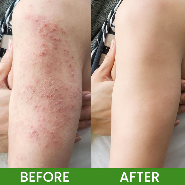 LIMETOW® Herbal Tinea Itching Cream image LIMETOW® Herbal Tinea Itching Cream - Image 12