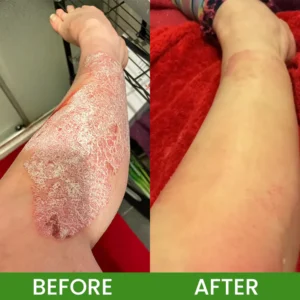 LIMETOW® Herbal Tinea Itching Cream image LIMETOW® Herbal Tinea Itching Cream