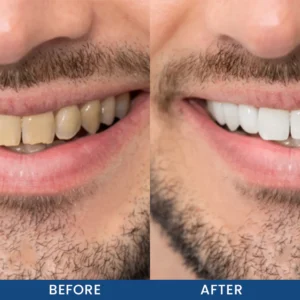 LIMETOW® Teeth Whitening Essence image LIMETOW® Teeth Whitening Essence