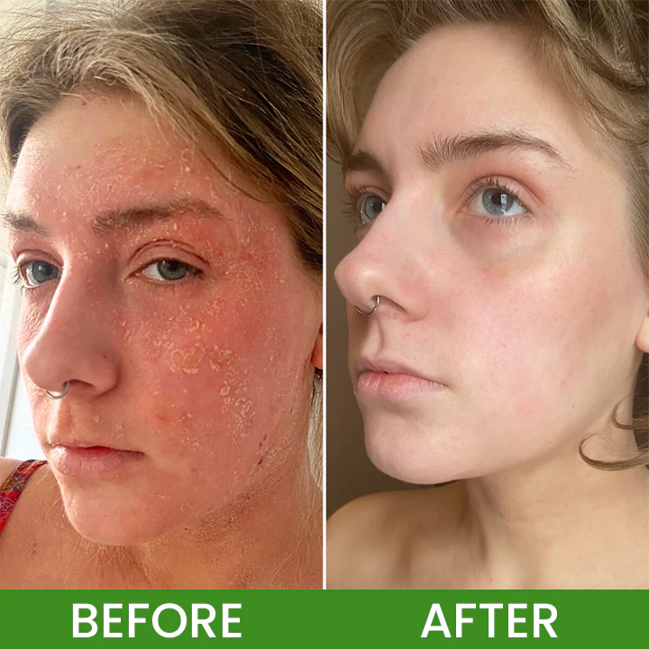 LIMETOW® Herbal Tinea Itching Cream image LIMETOW® Herbal Tinea Itching Cream - Image 11