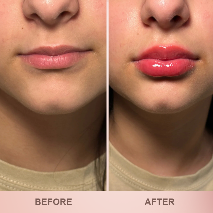 LIMETOW® Lip Plumper Kit image LIMETOW® Lip Plumper Kit