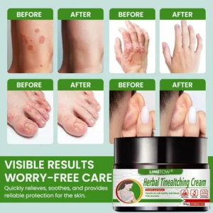 LIMETOW® Herbal Tinea Itching Cream image LIMETOW® Herbal Tinea Itching Cream