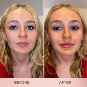 LIMETOW® Lip Plumper Kit image LIMETOW® Lip Plumper Kit