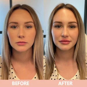 LIMETOW® Lip Plumper Kit image LIMETOW® Lip Plumper Kit