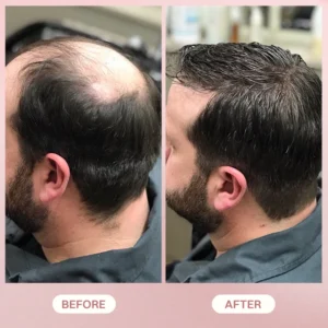 LIMETOW® H-Regrow 2.0 image LIMETOW® H-Regrow 2.0