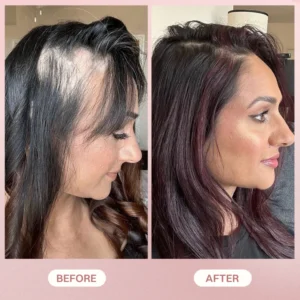 LIMETOW® H-Regrow 2.0 image LIMETOW® H-Regrow 2.0