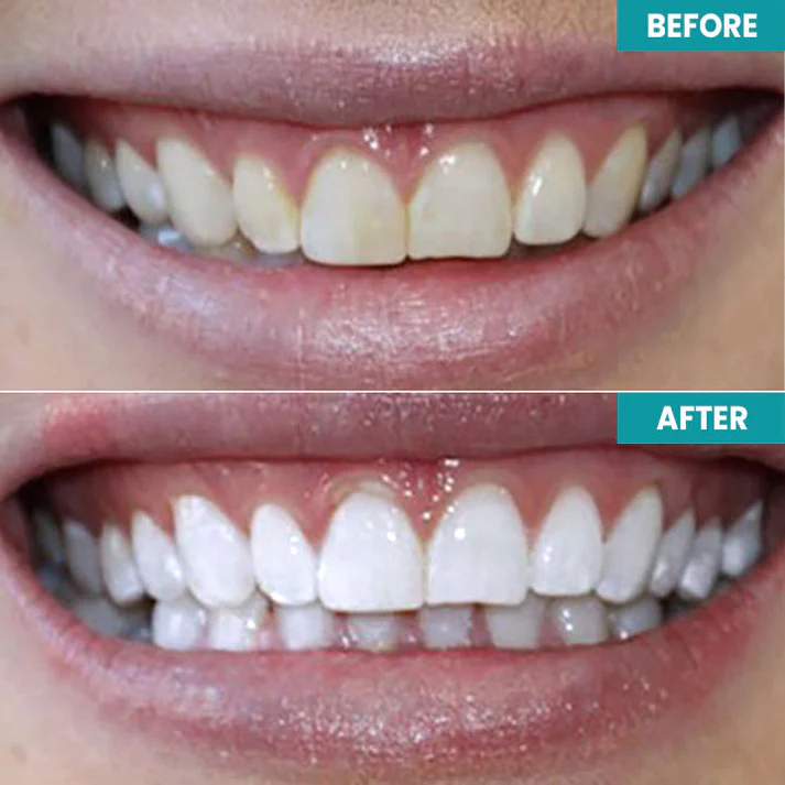 LIMETOW™ Instant Teeth Whitening Paint image LIMETOW™ Instant Teeth Whitening Paint
