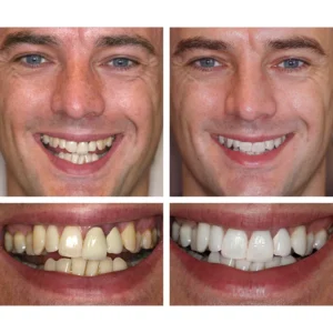 LIMETOW™ Teeth Whitening Essence image LIMETOW™ Teeth Whitening Essence